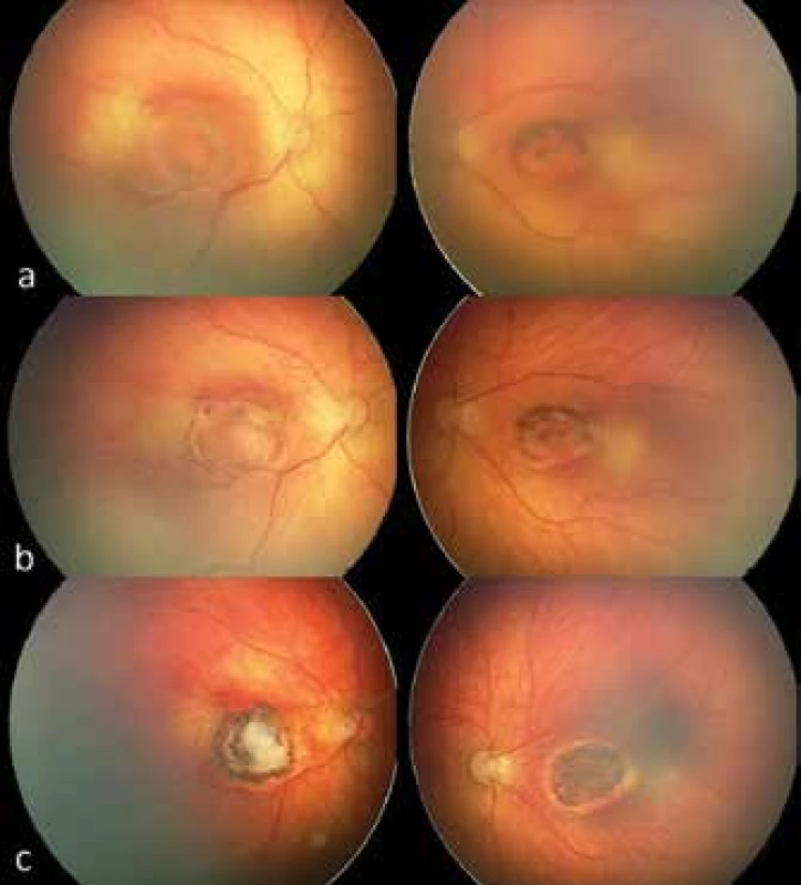 Central toxoplasmic chorioretinitis – retinal finding in boy
with congenital toxoplasmosis infection in both eyes. In the images
two weeks after the birth of the infant (fig. 4a) deposits of active
toxoplasmic chorioretinitis are identified, affecting the region of
the macula. The retinal finding at an interval of 4 weeks after the
commencement of general therapy shows subsiding inflammatory
activity and incipient retinal scarring (fig. 4b) and advanced chorioretinal
deposits of toxoplasmic etiology in the stage of atrophic
scar with pigmented edges, functionally characterised by irreversible
affliction of central visual acuity in the child (fig. 4c). Images
obtained using digital imaging system RetCam, 3rd generation.