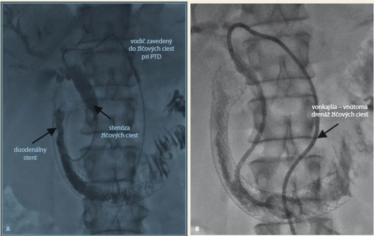 Duodenálný stent s vonkajšou – vnútornou PTD. Zdroj: Archív FN Trnava.<br>
Fig. 4. A duodenal stent with percutaneous transhepatic drainage. Source: Archive FN Trnava.