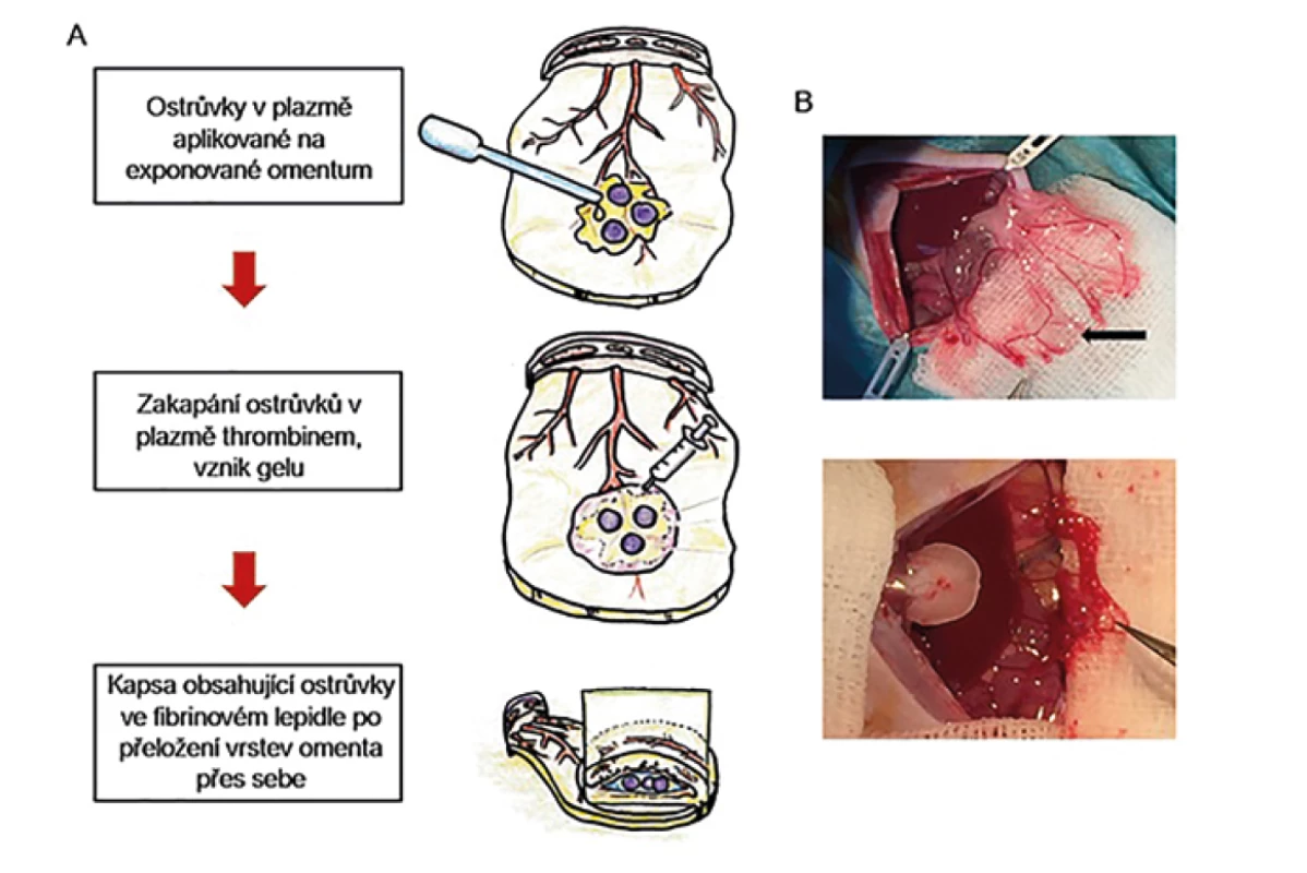 Transplantace Langerhansových ostrůvků do velkého omenta za použití biodegradabilního fibrinového lepidla<br>
A – schéma transplantačního postupu, B – experiment na zvířecím modelu, šipka ukazuje na štěp.<br>
Fig. 2: Pancreatic islets transplantation into the greater omentum using a biodegradable fibrin matrix<br>
A – transplantation process scheme; B – experiment in an animal model with the graft indicated by the arrow.
