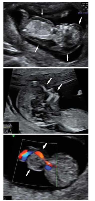 Edwardsův syndrom, prenatální fenotypové projevy:<br>
a) hydrops plodu,<br>
b) plochý obličej,<br>
c) omfalokéla.<br>
Fig. 1. Edwards syndrome, prenatal phenotypic manifestations:<br>
a) fetal hydrops,<br>
b) flat face,<br>
c) omphalocele.