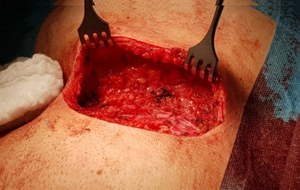 Mobilizace laloku<br>
Fig. 4: Flap mobilization