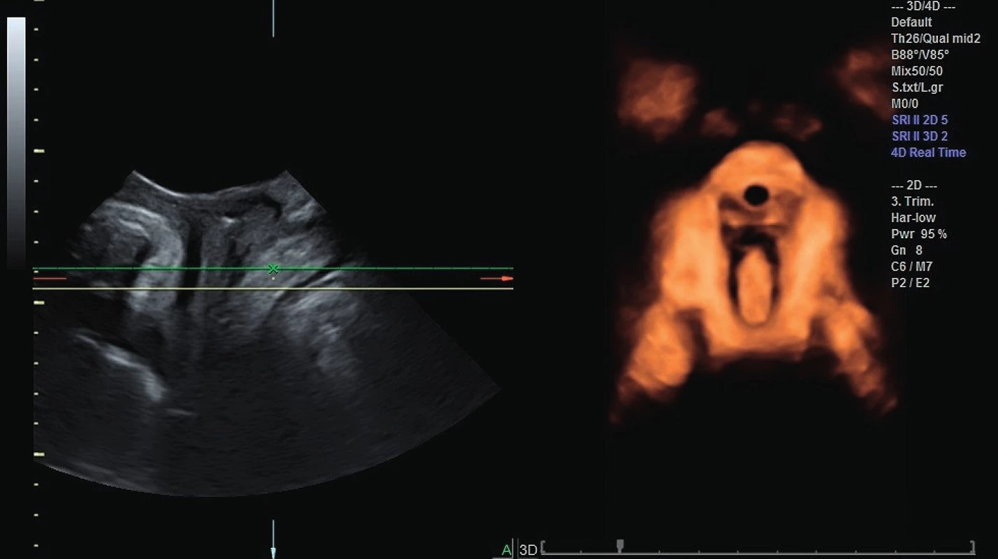 3D rekonstrukce svalů pánevního dna se zobrazením
urogenitální hiátu