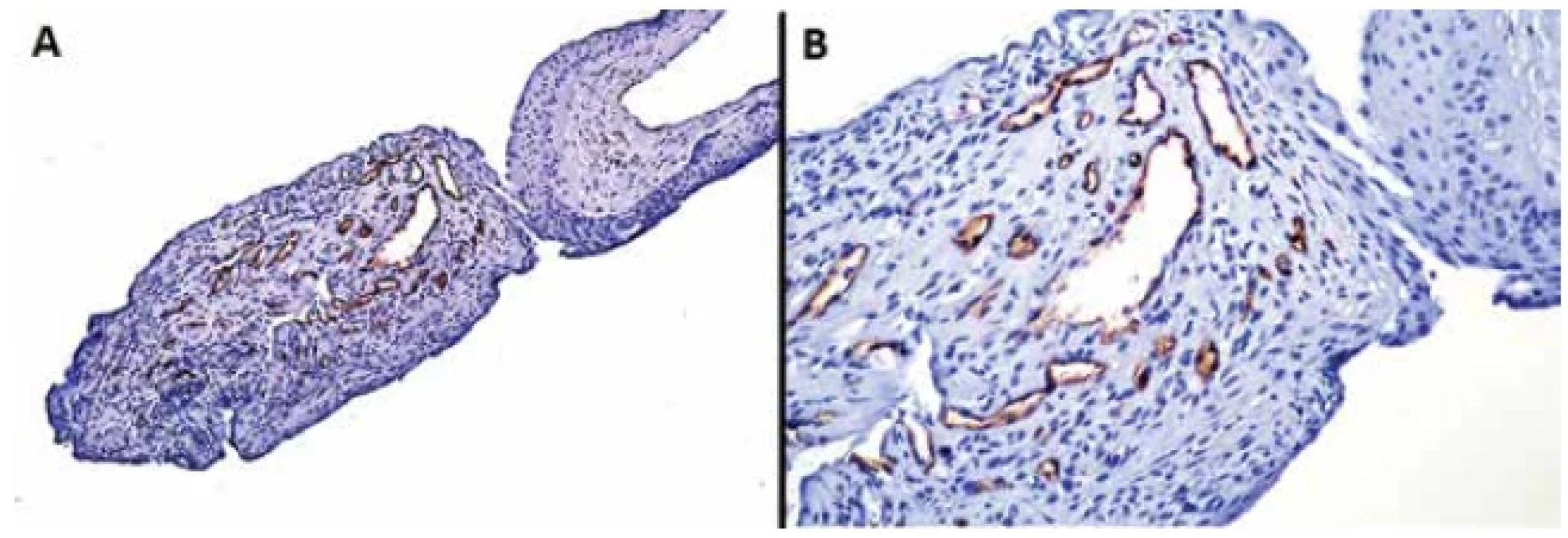 Immunohistochemistry staining shows positive reaction for CD34 in blood vessels (A), higher magnification
(B)