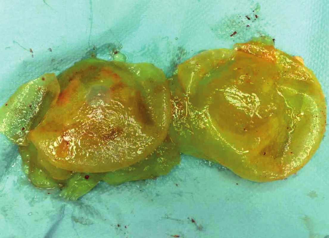 Removed implants 