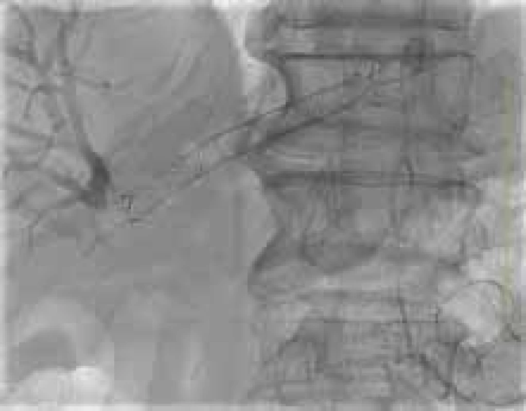 V jedné době vytvořená gastroenteroanastomóza
a hepatikogastroanastomóza.
Horní šipka – biliární
stenty, dolní šipka – lumen apoziční
metalický stent.<br>
Gastroenteroanastomosis and
hepaticogastroanastomosis formed at
one time. Upper arrow – biliary stents,
lower arrow – lumen-apposing metal
stent.
