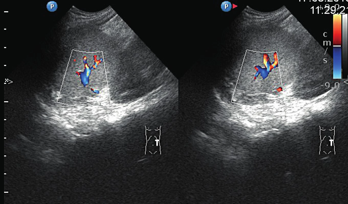 Sonografické znázornenie suficientných prietokov krvi
v zachovanej časti sleziny 3 mesiace po operácii.<br>
Fig. 3. Ultrasound visualization of sufficient blood flow in the
preserved part of the spleen 3 months after surgery.