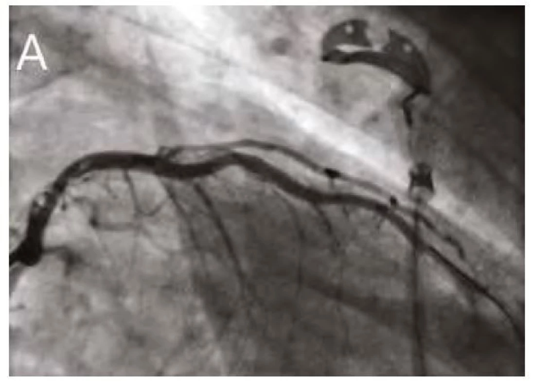 Finální angiografie RIA po PCI<br>
5A. Angiografie