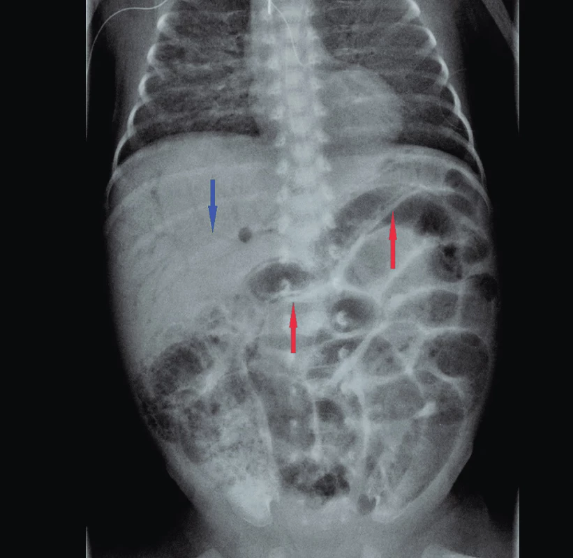 Nativní RTG s nálezem NEC – červené šipky označují
PCI (pneumatosis cystoides intestini), modrá šipka
znázorňuje přítomnost plynu ve větvích v. portae
(PVG).<br>
Fig. 1. Abdominal X-ray in NEC patient. Intramural bowel gas
(PCI) – red arrows; gas in the branches of portal vein
(PVG) – blue arrow.