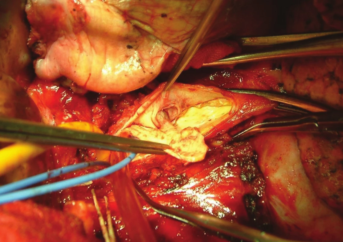 Extrakcia stentu z truncus coeliacus a lokálna
trombendarterektómia<br>
Fig. 4: Truncus coeliacus stent extraction and local trombendarterectomy