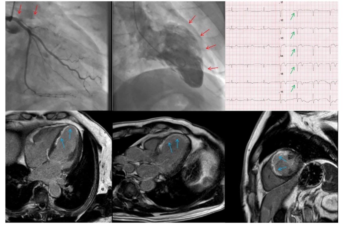 CTO ramus interventricularis anterior (RIA); vlevo nahoře angiografie, ostiální uzávěr RIA, nahoře uprostřed akineza přední stěny a hrotu levé
komory při levostranné ventrikulografii (červené šipky); vpravo nahoře EKG s patologickými Q kmity v oblasti přední stěny srdeční (zelené šipky); dole
snímky z magnetické rezonance s bíle vyznačeným převážně transmurálním postižením dané oblasti v LGE sekvenci (modré šipky) – CTO nevhodné
k intervenci