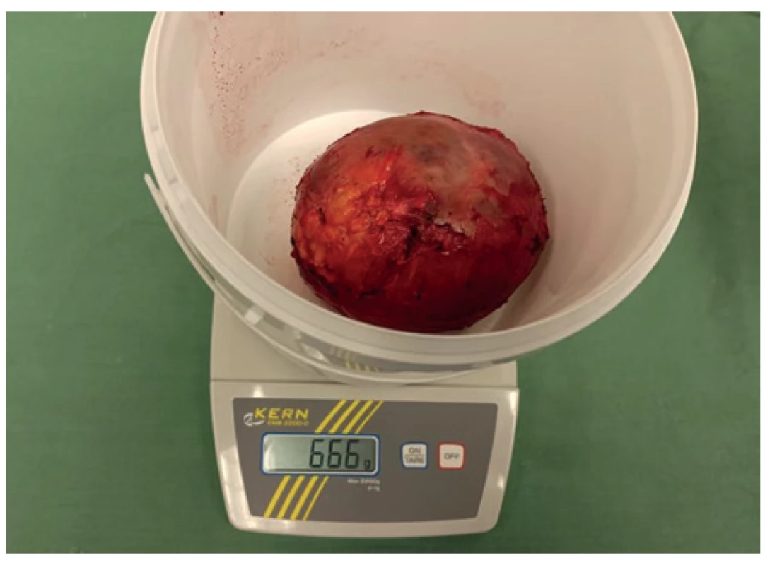 Makroskopická fotografie exstirpovaného tumoru s hmotností 666 g <br>
Fig. 4: Macroscopic photography of the removed tumor with weight of 666 g