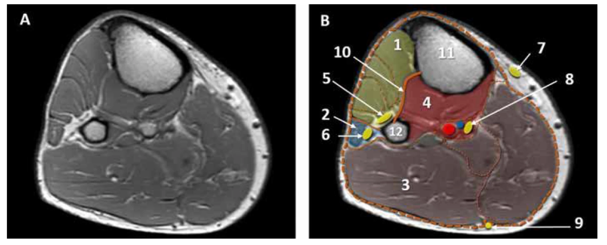 MRI horizontální řez lýtkem, lýtkové kompartmenty. A. nativní obraz. B. kolorovaný obraz: 1. přední kompartment, 2. laterální kompartment,
3. zadní povrchní kompartment, 4. zadní hluboký kompartment, 5. n. peroneus profundus, 6. n. peroneus superficialis, 7. n. saphenus, 8. n. tibialis. 9. n. suralis,
10. membrana interossea, 11. tibie, 12. fibula