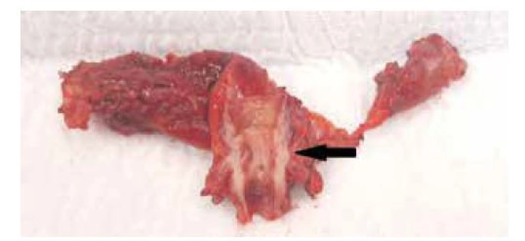 Segmentální resekce žlučových cest, resekát s cholangiokarcinomem
středního žlučovodu (černá šipka)<br>
Fig. 2: Bile duct segmental resection, specimen with middle
bile duct cholangiocarcinoma (black arrow)