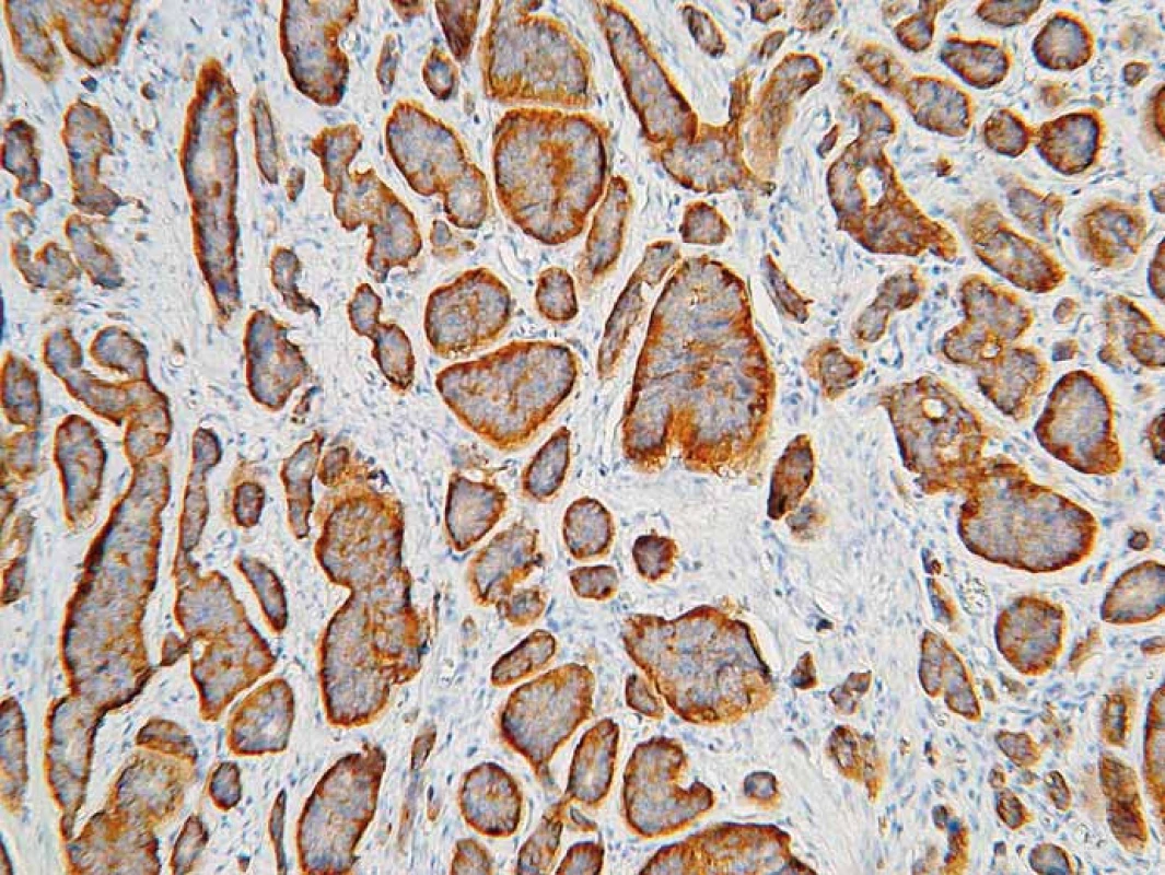 Neuroendokrinný nádor. Imunohistochemické vyšetrenie s protilátkou proti synaptofyzínu. Silná difúzna pozitivita. 3,3-diaminobenzidín, 200×.