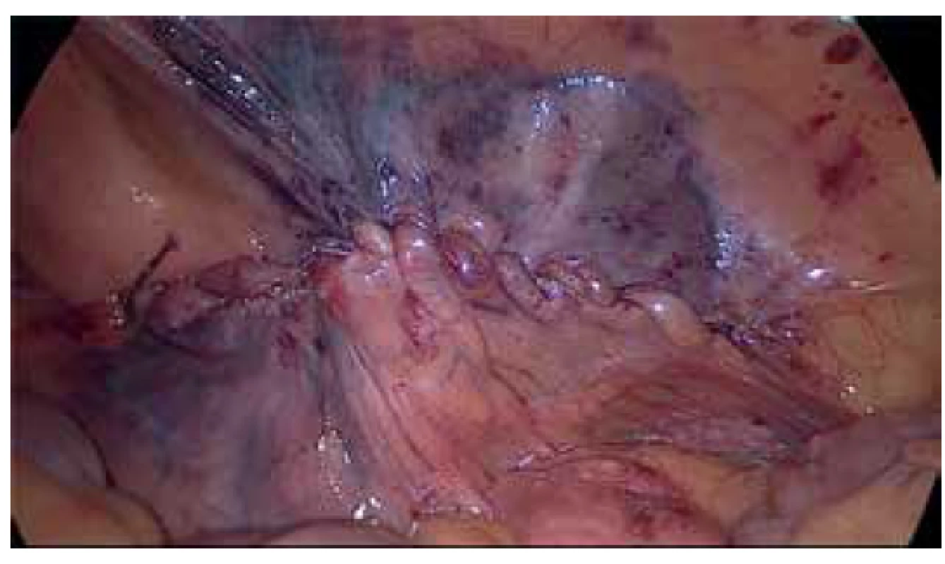 Sutura peritonea<br>
Fig. 4. Closure of the peritoneum