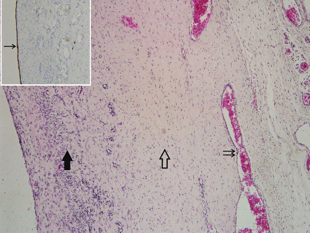 Stěna cysty ductus thoracicus (barvení hematoxylinosin).
Patrné podélně (plná šipka) i příčně (prázdná šipka) orientované
snopce hladkého svalu v tunica media a v ní se nacházející
krevní cévy (dvojšipka). Cysta je kryta velmi plochým, D2-40 pozitivním
endotelem (inset, šipka).