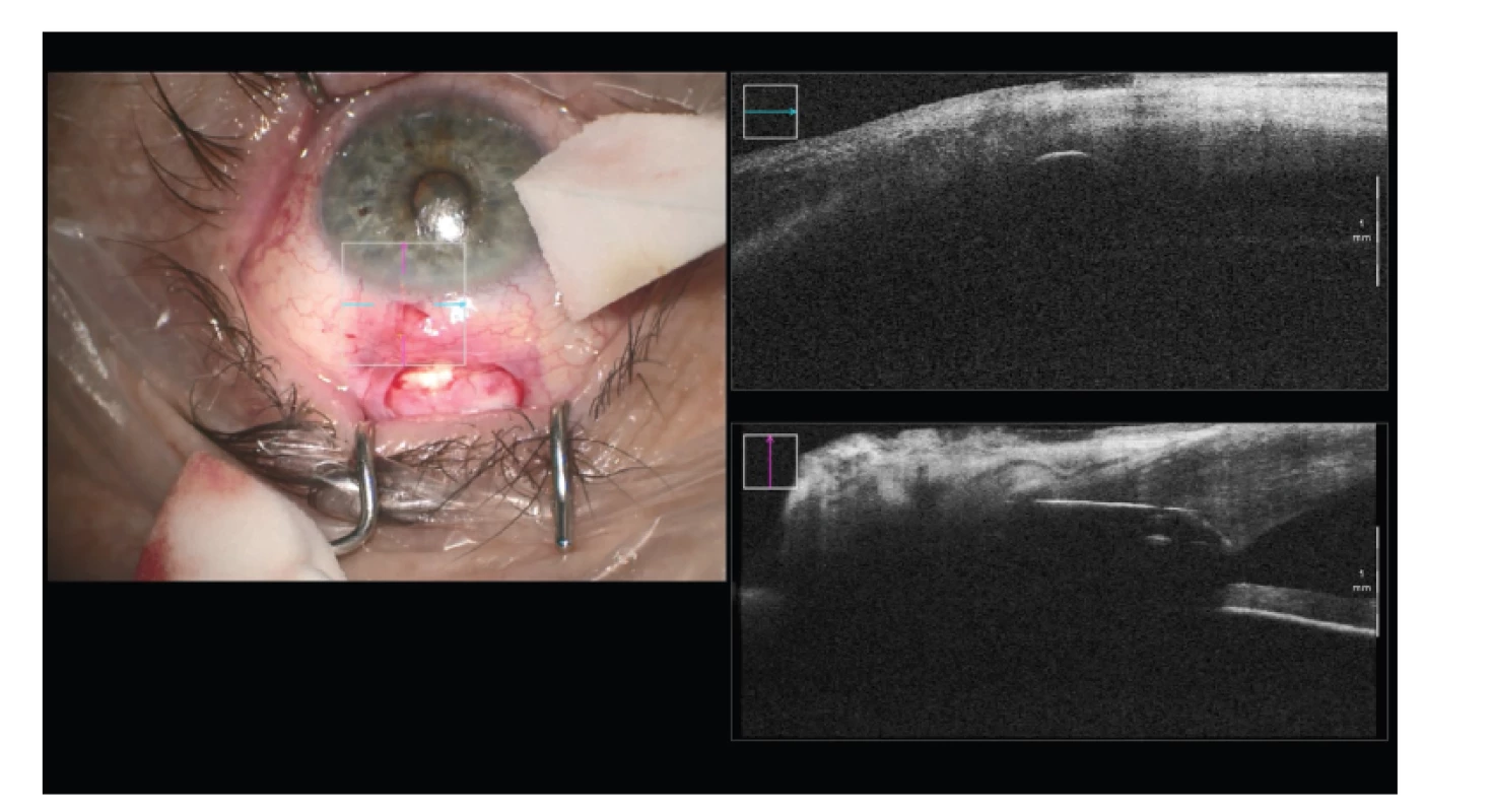 Reimplantace glaukomového implantátu Ex-press – špatná pozice ústí intubace
v rohovkovém stromatu
