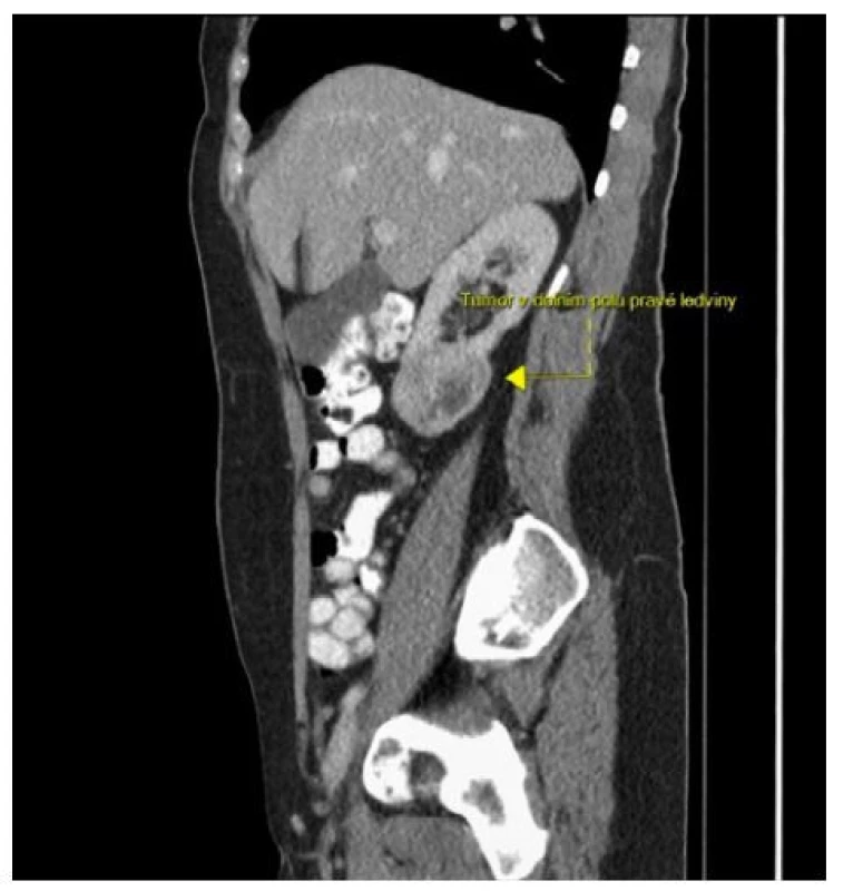 CT s kontrastní látkou, venózní fáze, sagitální
řez: částečně nekrotický tumor dolního pólu pravé
ledviny velikosti 5 cm; zdroj: Radiologické oddělení
Nemocnice Most<br>
Fig. 4. Contrast-enhanced CT, venous phase, sagittal
section: partially necrotic tumor of the lower pole
of the right kidney with a size of 5 cm; source: Department
of Radiology, Most Hospital