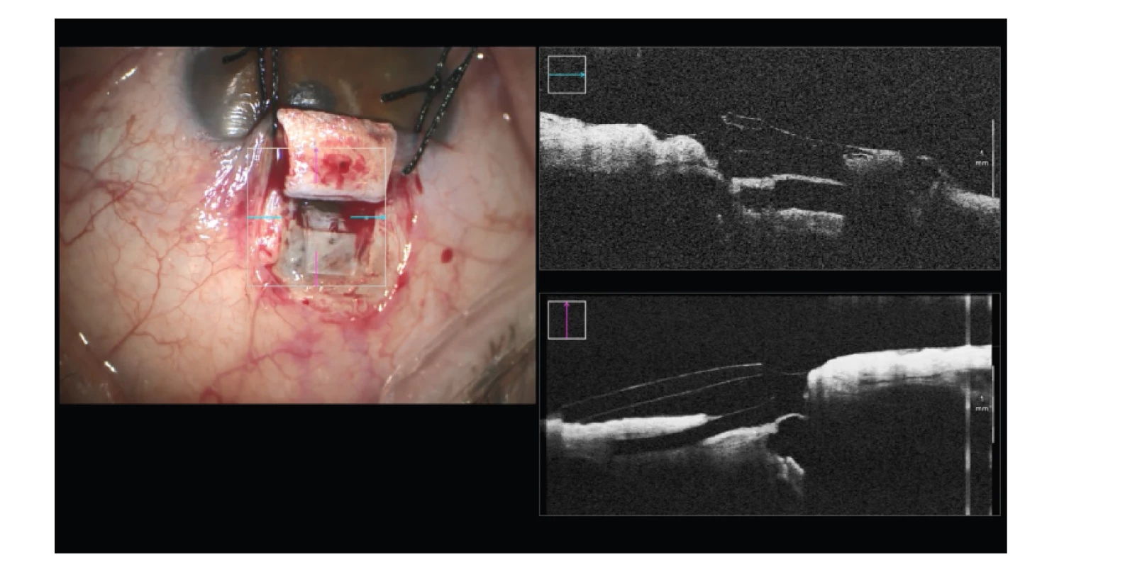 Hluboká sklerektomie s implantací subchoroidálního implantátu Esnoper
Clip – kontrola jeho pozice a celistvosti stěny Schlemmova kanálu
