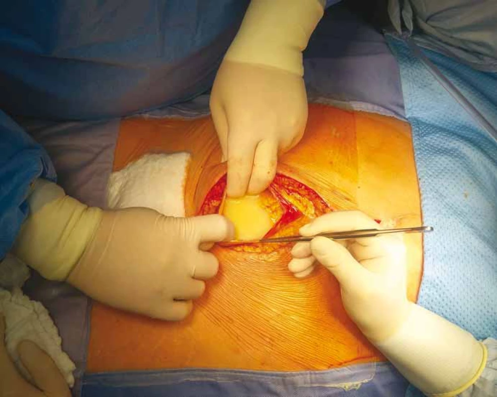 Foto z operace – otevření dutiny břišní a patrná mléčná sekrece, tzv. chylózní ascites
neboli chyloperitoneum.