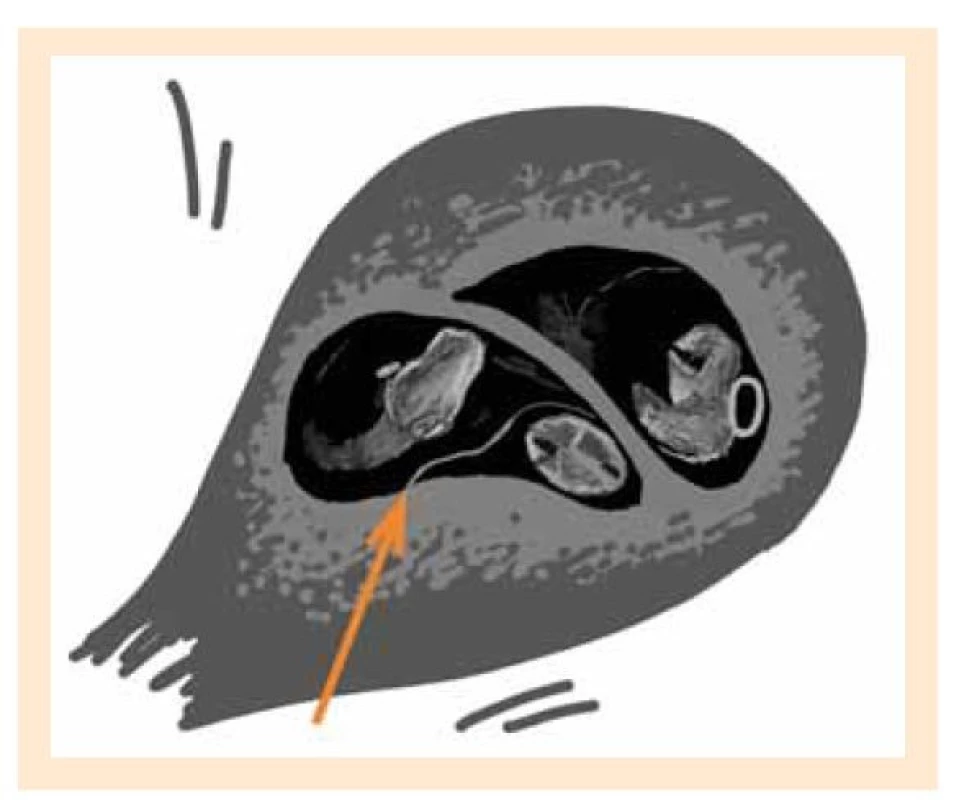 a. T-sign, schematické znázornění ultrazvukového
nálezu (autor: Osičková V).<br>
Fig. 2a. T-sign, schematic representation of an ultrasound
finding (author: Osičková V).