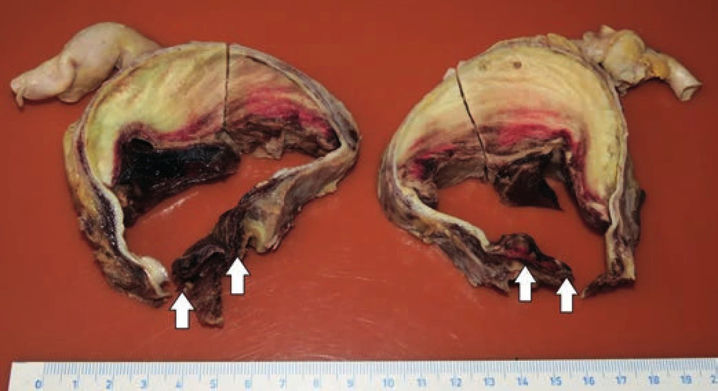 Transverse cut through the lumen of the aortic arch intersecting the
defect no. 3 (arrows).