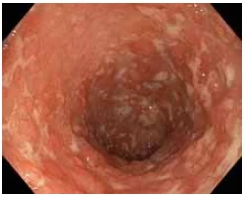Aktivní fáze ulcerózní kolitidy se
spontánním krvácením a ulceracemi –
Mayo endoskopické subskóre 3. <br> 
Fig. 1. Active phase of ulcerative colitis with
spontaneous bleeding and ulcerations –
Mayo endoscopic subscore 3.