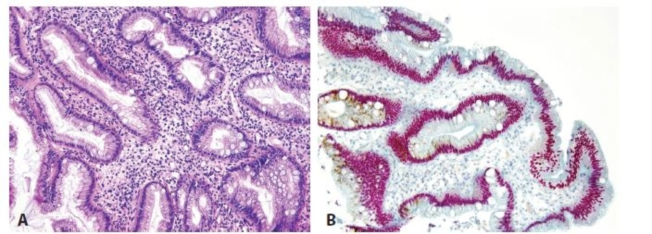 Esophageal incomplete intestinal metaplasia. A. Cylindrical cells with mucin production and without brush border. B. Double
immunohistochemical reaction shows nuclear positivity for CDX2 (red) and cytoplasmic expression for MUC5AC (brown). No
cell with negativity of CDX2 and positivity of MUC5AC is seen (original magnifications 200x).