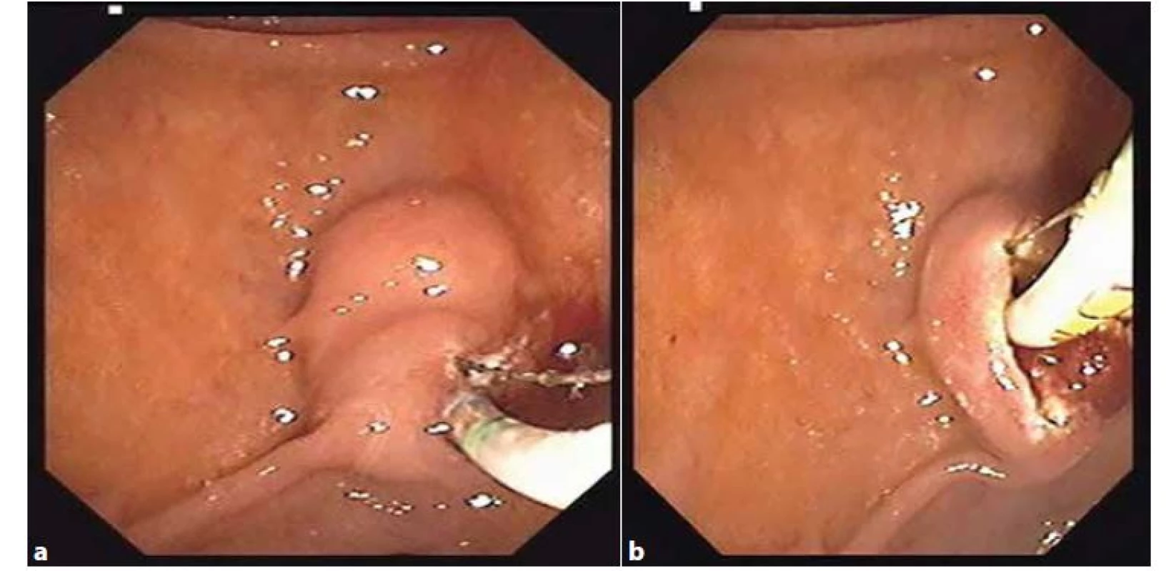 a, 3b: Endoskopická papilosfinkterotomie<br>
Fig. 3a, 3b: Endoscopic papilosphincterotomy