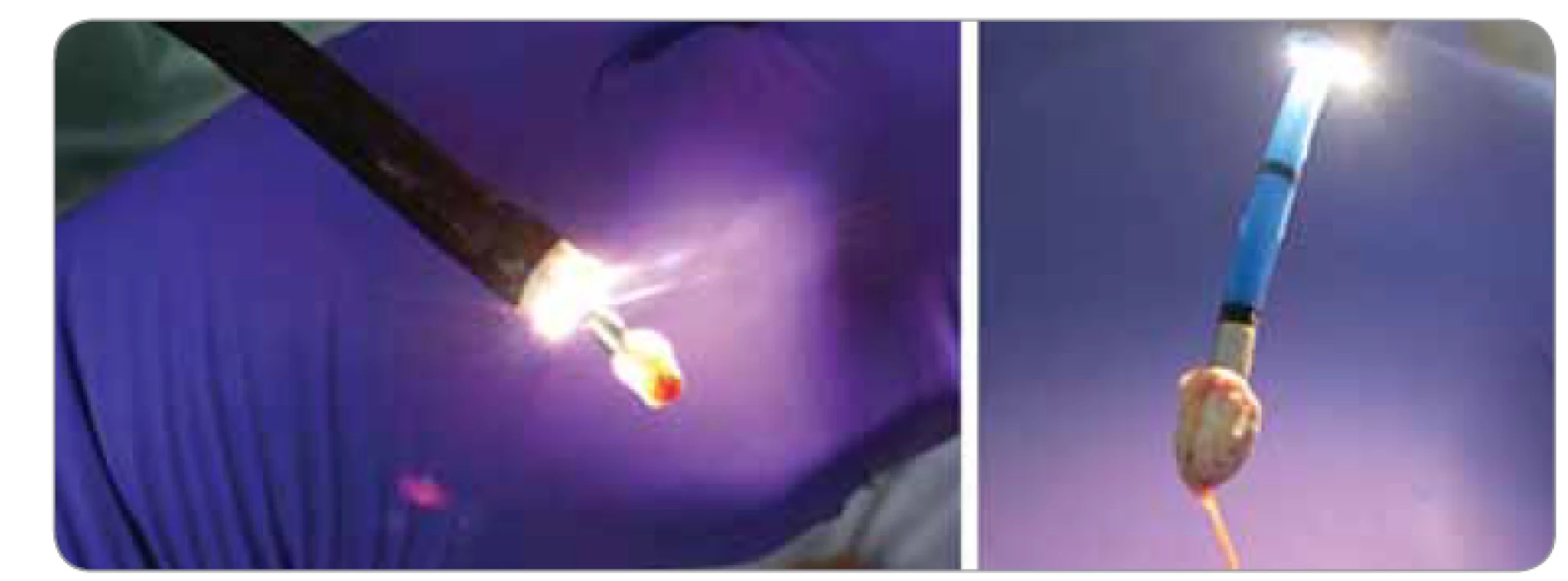 Vzorky nádorové tkáně získané kryoexcizí.