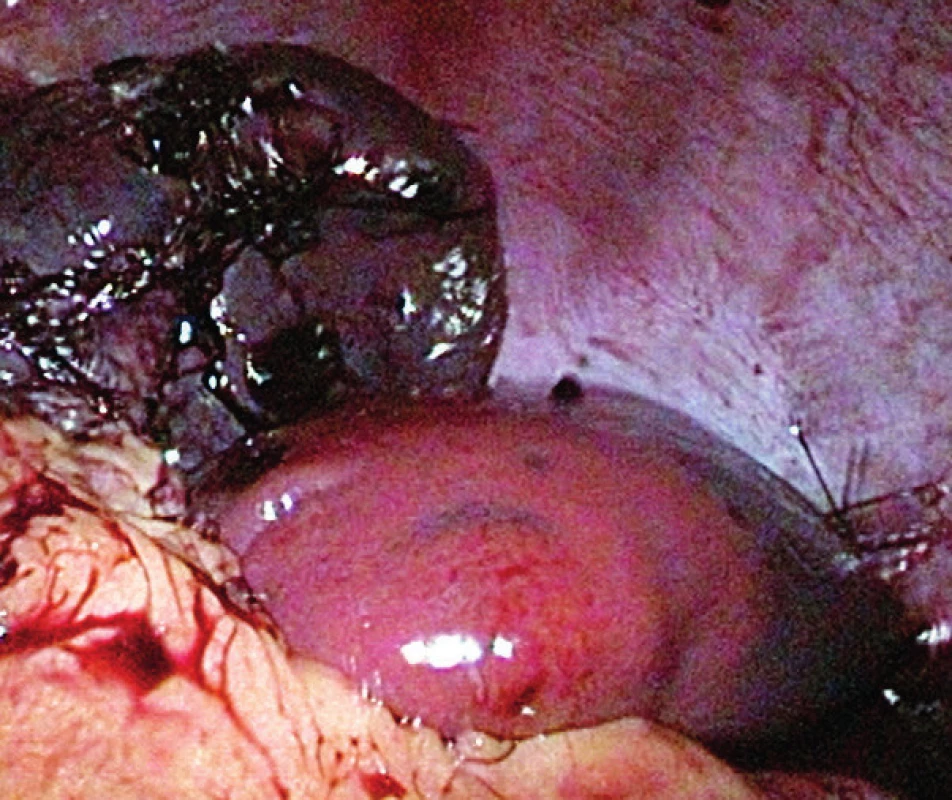 Laparoskopický pohľad na remnant sleziny s dobrou
vitalitou.<br>
Fig. 2. Laparoscopic view of the remnant of the spleen with
good vitality.