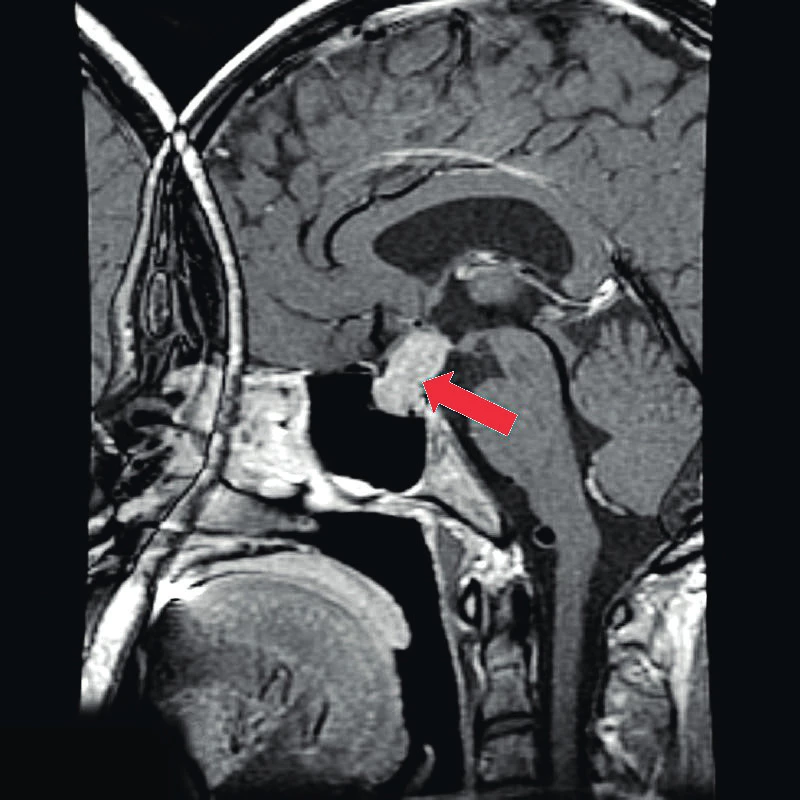 Magnetická rezonance mozku. Autoimunitní hypofyzitida. Zvětšená hypofýza homogenní hyperintenzity.
(Zdroj: Lymphocytic hypophysitis | Radiology Reference Article | Radiopaedia.org.
Radiopaedia.org, the wiki-based collaborative Radiology resource [online].
Copyright© 2005 [cit. 27.03.2020]. Dostupné z: https://radiopaedia.org/articles/
/lymphocytic-hypophysitis)<br>
Fig. 3. Magnetic resonance imaging of the brain. Autoimmune hypophysitis. Enlarged pituitary gland of homogeneous hyperintensity