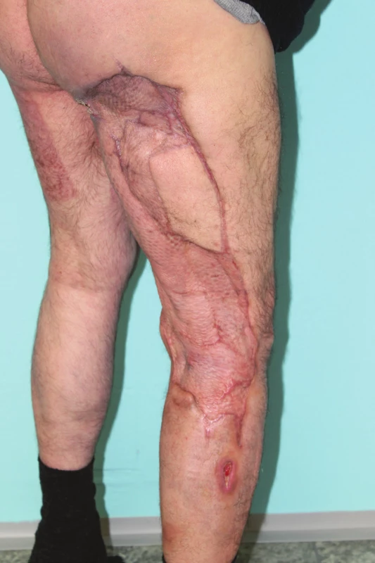 Stav při ambulantní kontrole 6. 11. 2017<br>
Fig. 7: Status during the outpatient check on 6 November
2017