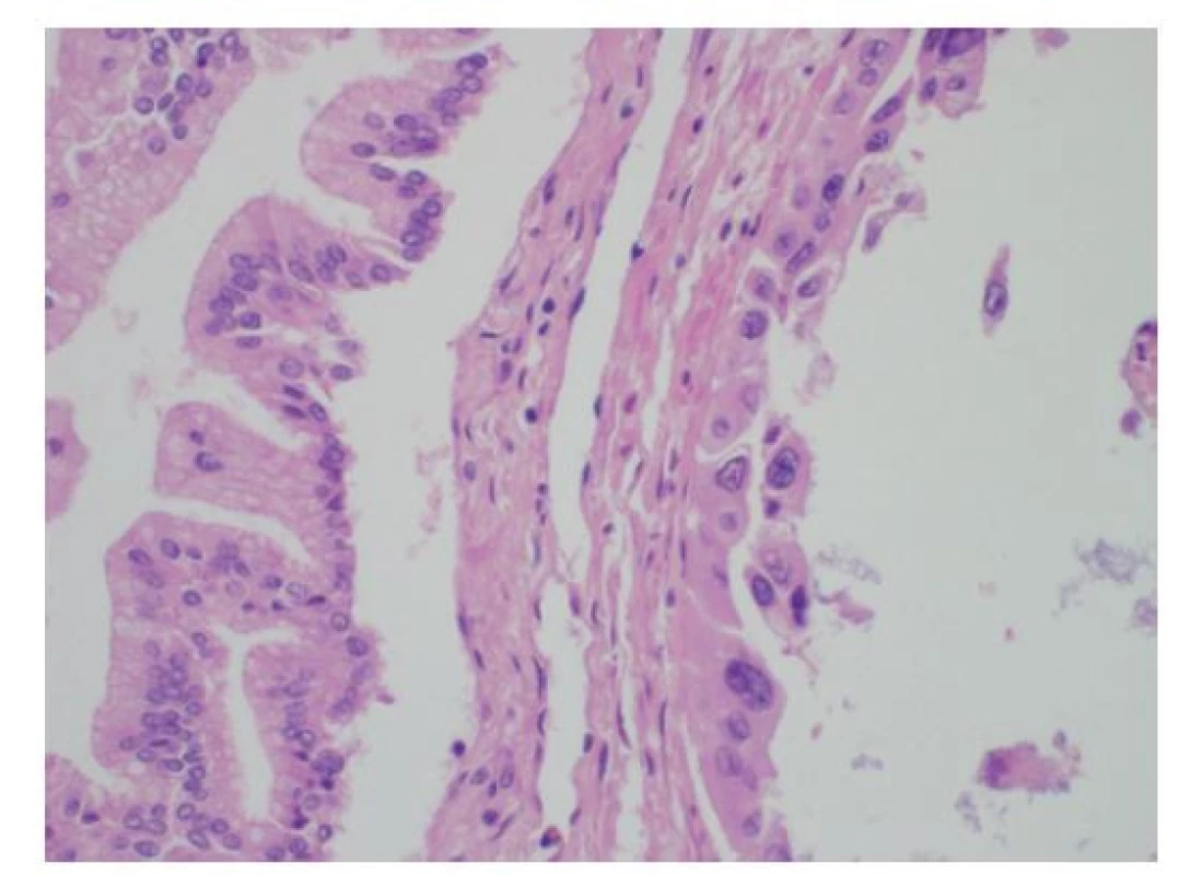 Histologie lehké dysplazie žlučovodu BiIN1b
s papilárně utvářeným vysokým mucinózním cylindrickým
epitelem s bazálně uloženými jádry (vlevo) a těžké
dysplazie BiIN3 s nápadnými jadernými atypiemi a ztrátou
polarity epitelu (vpravo), HE, 400×<br>
Fig. 10: Histology of a low-grade bile duct dysplasia
BiIN1b with polarized papillary tall columnar mucin-producing
epithelium (on the left); high-grade dysplasia
BiIN3 with marked cytonuclear atypia and loss of epithelium
polarity (on the right); HE, 400×