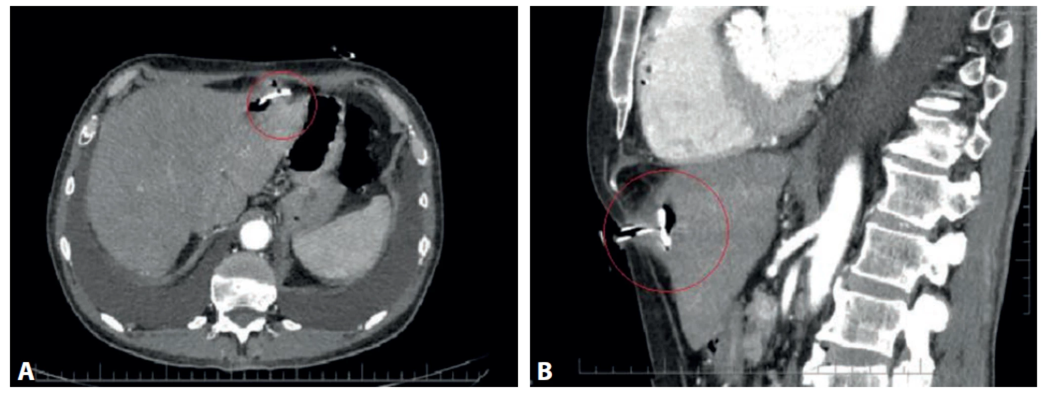 CT vyšetrenie s nálezom dislokovaného PEG a hepatálnym abscesom (červený krúžok):<br>
a) axiálna projekcia, b) sagitálna projekcia<br>
Fig. 1. CT scan with PEG dislocation and hepatic abscess (red circle):<br>
a) axial projection, b) sagittal projection