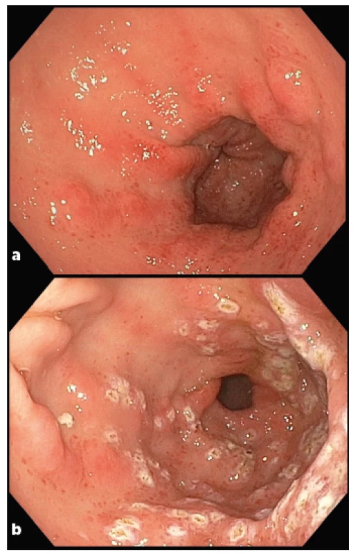 Gastrické antrální vaskulární ektázie (GAVE) u pacienta
se SSc (laskavě poskytl MUDr. Bohuš Bunganič z Interní kliniky –
oddělení gastroenterologie, hepatologie a metabolismu 1. LF UK
a ÚVN, Praha)<br>
2a Diagnostické vyšetření: cévní ektázie v antru žaludku
směřující od pyloru připomínající uspořádáním vodní meloun
(watermelon stomach). Hyperemie a edém sliznice, které vznikají na
podkladě dilatovaných kapilár s tromby, fibromuskulární hyperplazie
lamina propria a abnormálního uspořádání cév v submukóze.<br>
2b Po ošetření argon plazma koagulací: černé až bělavé
okrsky ošetřené tkáně zasahující do submukózy.