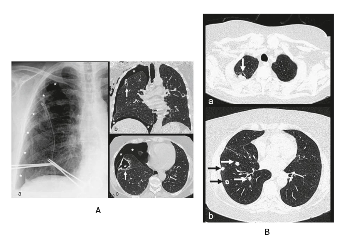 Revmatoidní plicní nodulóza s kavitacemi a pneumothoraxem u 64leté ženy s RA stupeň III (LFT: l: 2560, aCCP2: 3424 U/ml) –
histologická verifikace plicních uzlů, BK negativní, PCR-DNA aspergilus negativní, Pneumocystitis jiroveci: 6760 kopií/ml, leflunomid 20 mg
(2014–2019), subj. (2019) bez obtíží, pracující důchodkyně<br>
A – RTG plic (a) a HRCT (b, c): kavitované tenkostěnné ložisko subpleurálně (↑) s navazujícím pneumothoraxem (*) v roce 2014 (vstřícně
zapůjčeno z archivu RDG oddělení nemocnice Svitavy, popis s laskavostí MUDr. J. Brtkové, Radiologická klinika LF UK a FN Hradec Králové),<br>
B – HRCT plic (a, b): kavitované ložisko se suspektním mycetomem v pravém plicním hrotu (↓) a vícečetná drobná plná/kavitovaná ložiska
v subsegmentech vpravo (→) v roce 2016 (Archiv Radiologické kliniky LF UK a FN Hradec Králové s laskavostí MUDr. J. Brtkové)