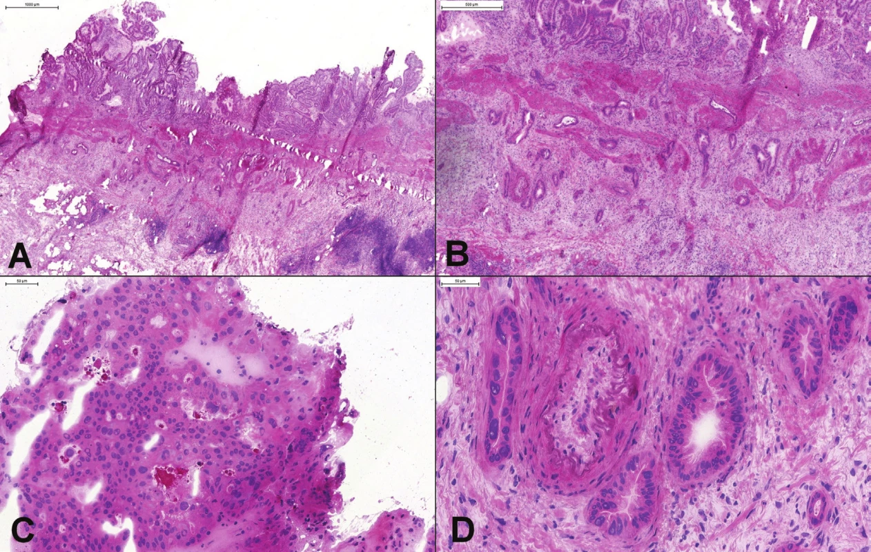 (A, B) Peroperačné vyšetrenie polypoidnej lézie žlčníka, ktorá bola zistená radiologickým vyšetrením pred odberom orgánov
od žijúceho darcu. Okrem polypoidnej lézie boli vo svalovej vrstve prítomné náhodne rozmiestnené angulované žliazky,
niektoré s horizontálnym priebehom. (C) V polypoidnej časti boli jednoznačne prítomné high-grade dysplatické zmeny (BilIN-3).
(D) Atypické žlazky v tesnej blízkosti muskulárnej artérie. Diagnóza dobre diferencovaného adenokarcinómu bola potvrdená aj
definitívnym vyšetrením. Odber orgánov bol zrušený.