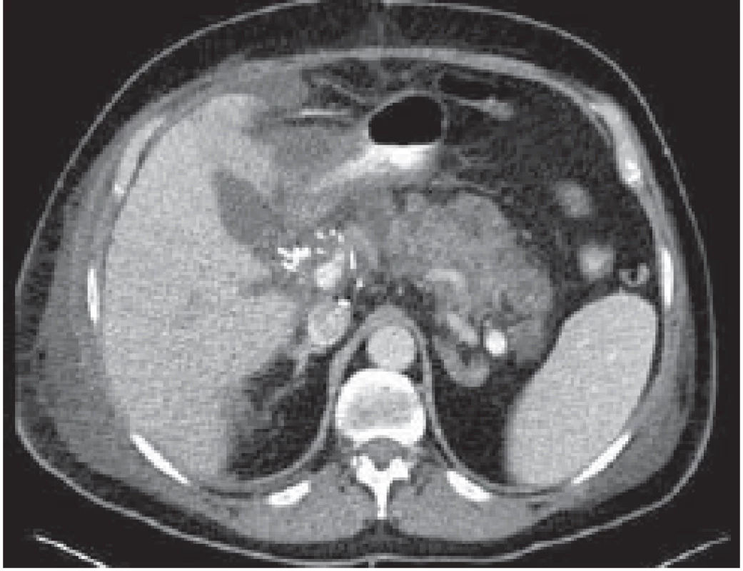 CT obraz nekrotizující
akutní pankreatitidy u pacienta po
transplantaci jater.<br>
CT image of necrotizing acute
pancreatitis in a patient after liver
transplantation.