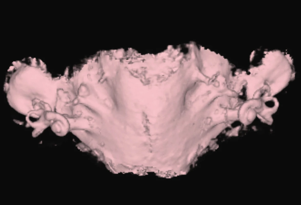 EVA syndrom, syndrom rozšířeného vestibulárního
akvaduktu.<br>
Fig. 6. Enlarget vestibular aquaeduct.