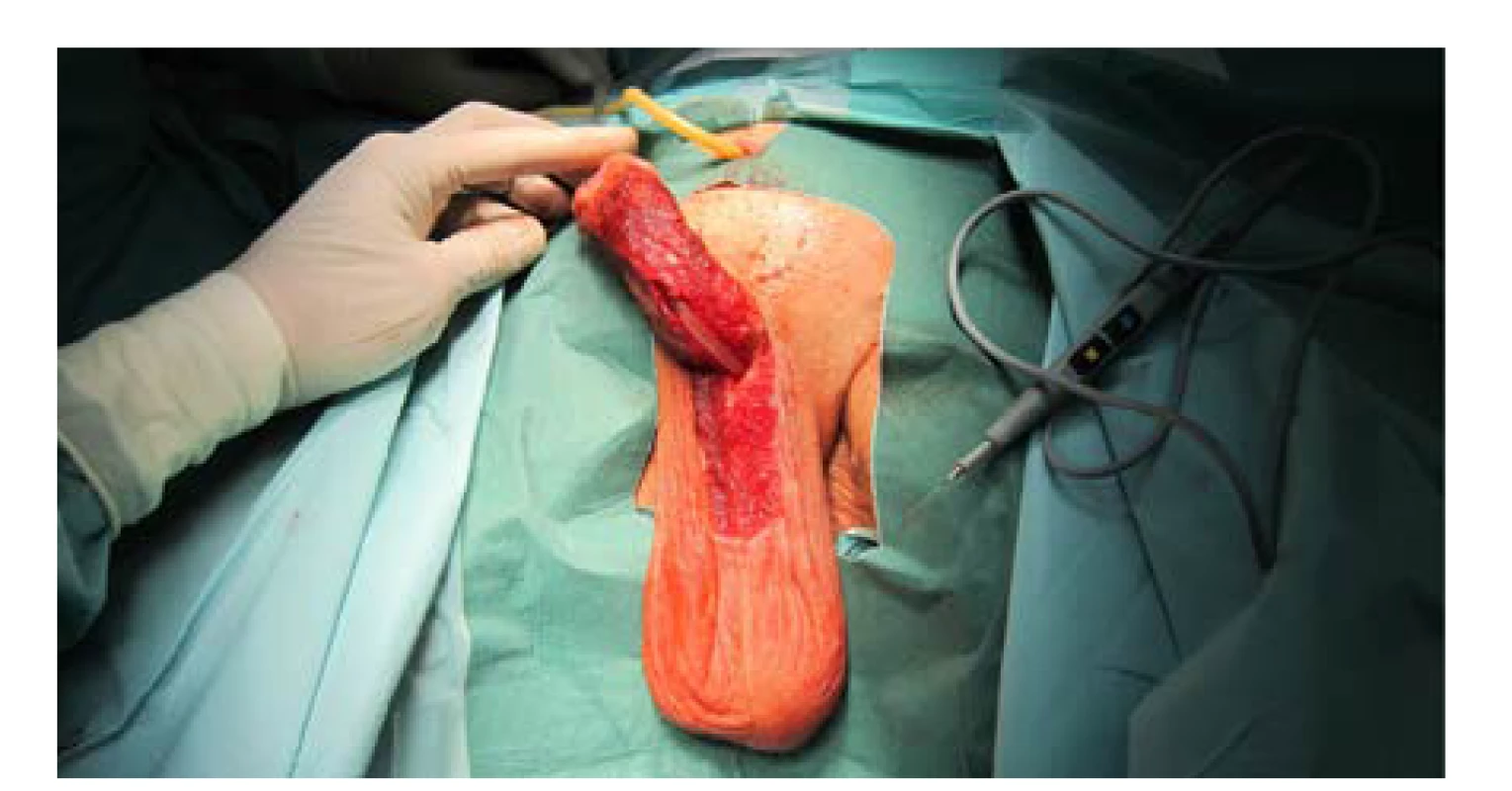Defekt uretry patrný po zavedení Foley katétru
Ch 16 transuretrálně; oba konce uretry předtím
kalibrovány do Ch 22<br>
Fig. 5. Urethral defect noticeable after insertion of a Ch 16
Foley catheter transurethrally. Both urethral ends previously
calibrated for Ch 22