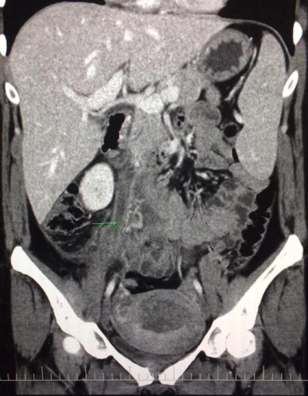 CECT 8th postpartum day: right ovarian vein thrombosis
(green mark), congestive enlarged right adnexa, hepatomegaly
and splenomegaly