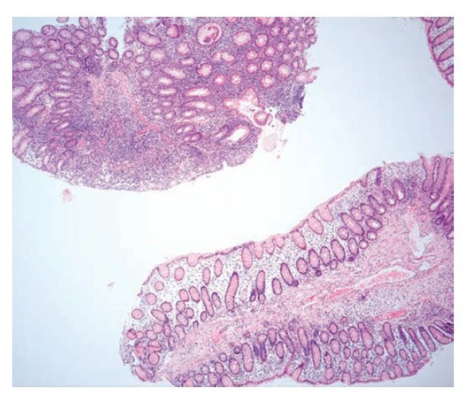 Bioptický odběr kolické sliznice u pacienta s Crohnovou chorobou.
Patrný je kolísavý charakter zánětu, kdy se střídají úseky bez zánětu pouze se
stromálním edémem, s úseky prostoupenými intenzivní chronickou aktivní
zánětlivou celulizací (hematoxylin a eosin, 40x).