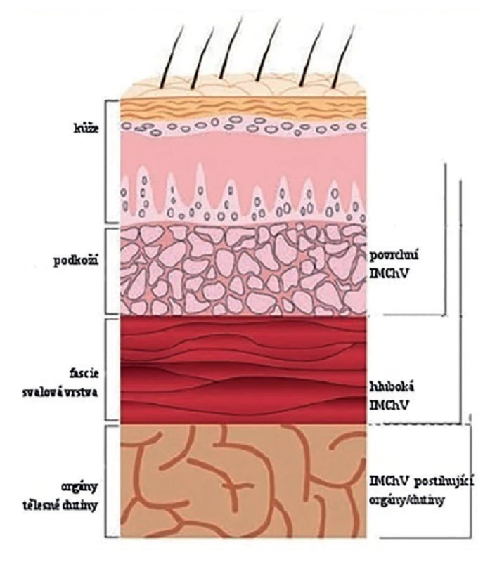 Typy infekcí v místě chirurgického výkonu, převzato z Horan a kol. <br>
Fig. 1: Surgical site infection types, adapted from Horan et al. 