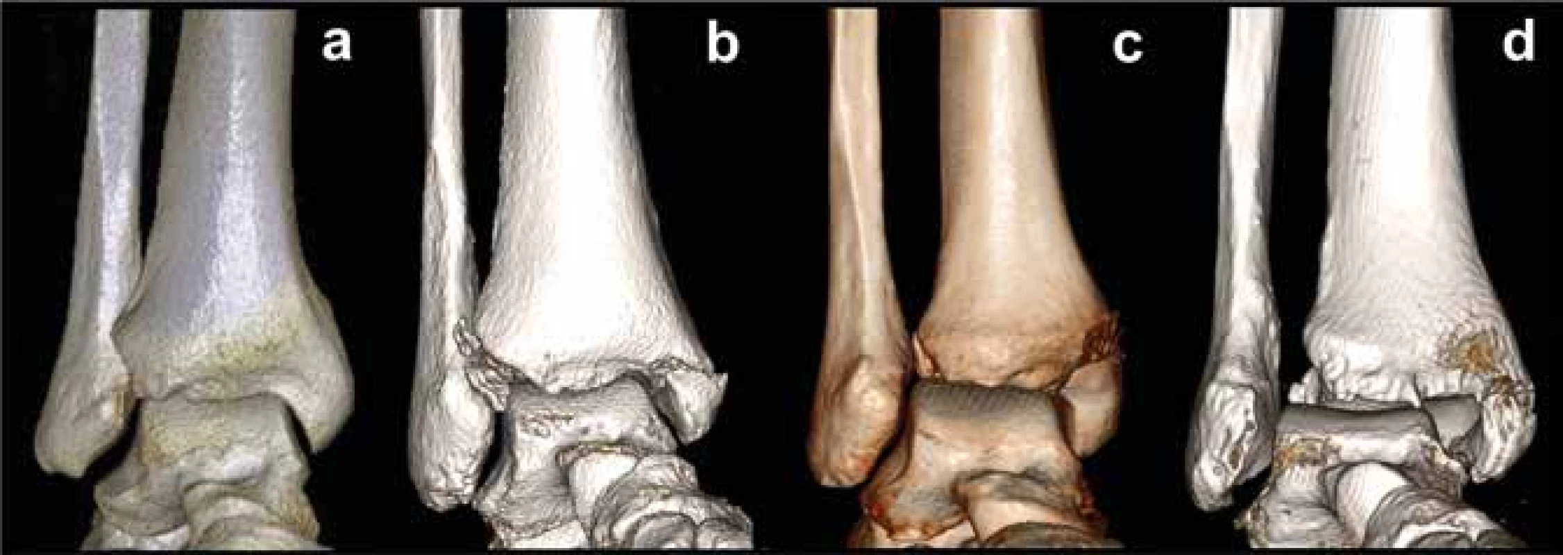 Poranění tibiofibulární syndesmózy na 3D CT rekonstrukcích
a+b+c+d - postupné rozšíření tibiofibulární vidlice.<br>
Fig. 9. 3D CT reconstructions of an injury to the tibiofibular syndesmosis
a+b+c+d – gradual widening of the tibiofibular mortise.