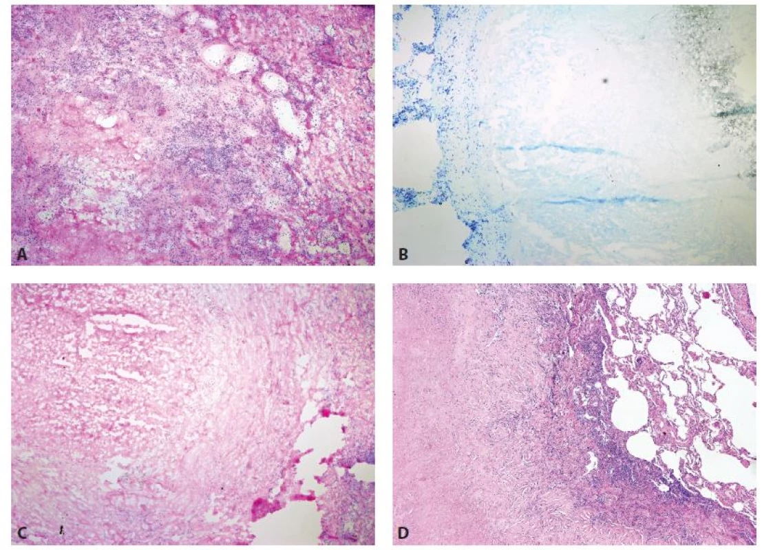 Nekrotizující granulomatózní plicní procesy v peroperačním vyšetření. A, B: Tuberkulóza (zvětšení 40x, A HE, B Toluidinová modř). C: Revmatoidní uzel
(zvětšení 40x, HE). D: Revmatoidní uzel (definitivní řez, zvětšení 40x, HE).