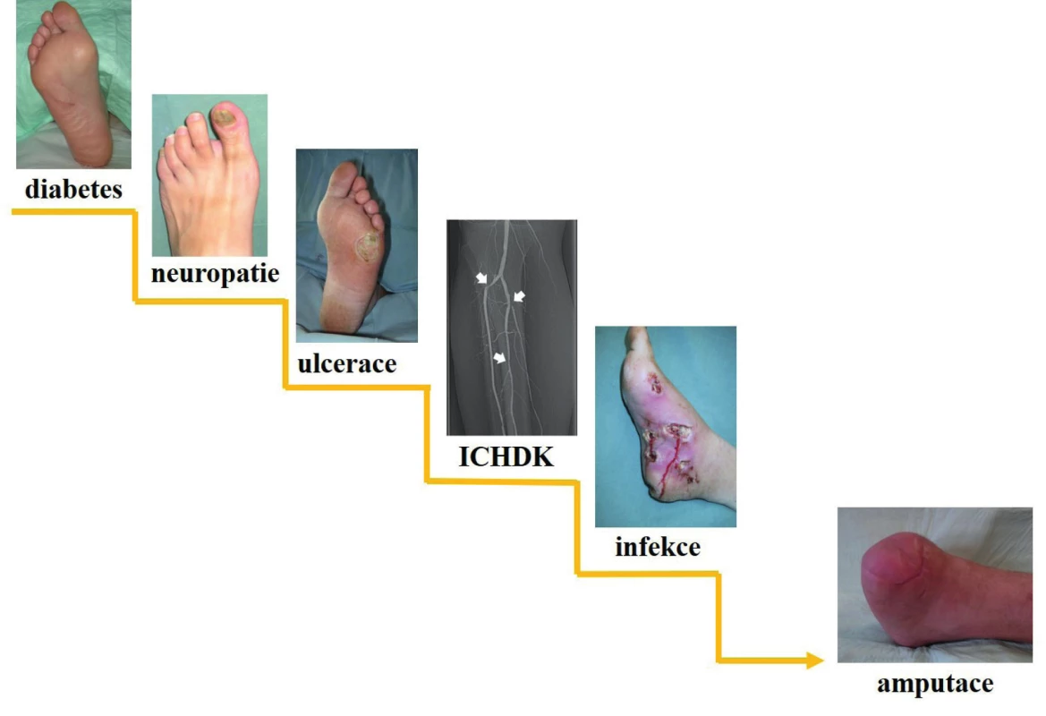 Schody k amputaci