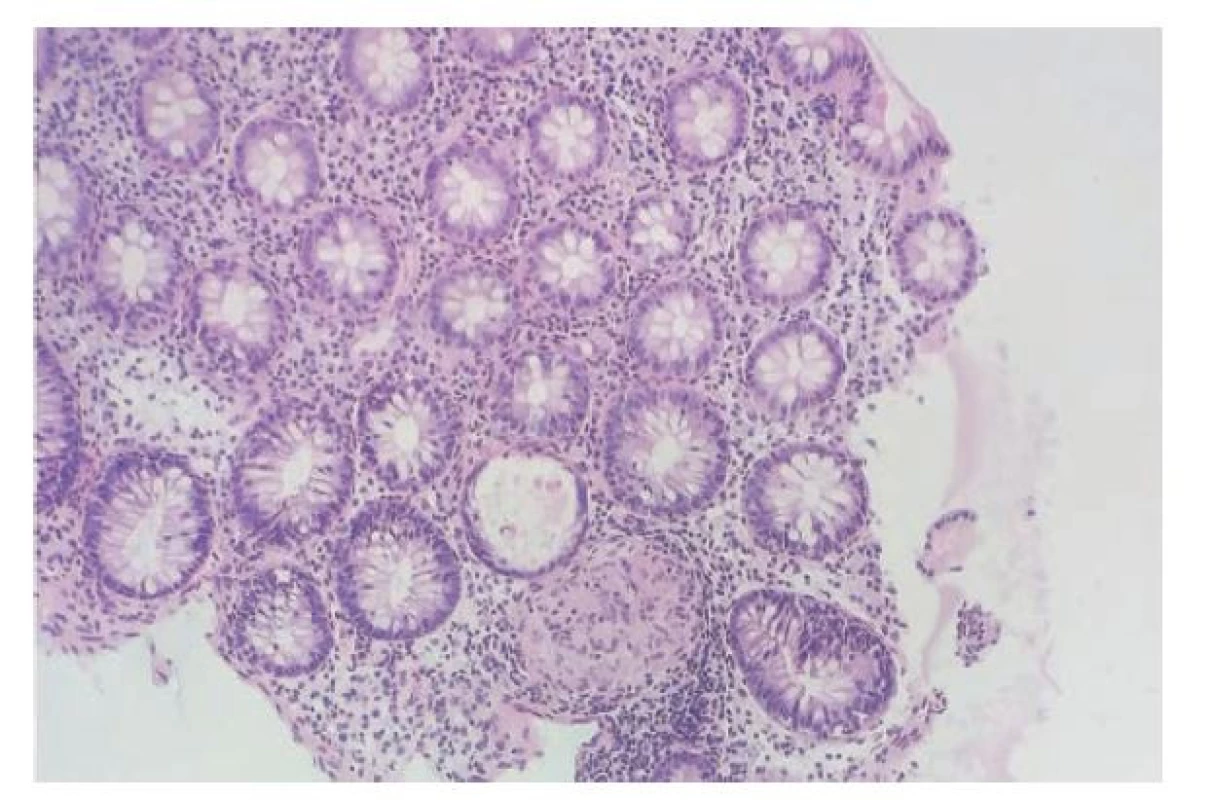 Granulomatózní kolitida. Kolická sliznice má zachovalou architektoniku.
V lamina propria je jen velmi mírná chronická zánětlivá celulizace
bez známek aktivity zánětu. V dolní části obrázku je zastižen dobře formovaný
epiteloidní granulom bez přítomnosti nekrózy. V diferenciální diagnóze
přichází v úvahu zejména Crohnova choroba, vyloučit však nelze ani jiné
příčiny ne-nekrotizujících granulomatózních kolitid jako např. intestinální
sarkoidózu (hematoxylin a eosin; 200x).