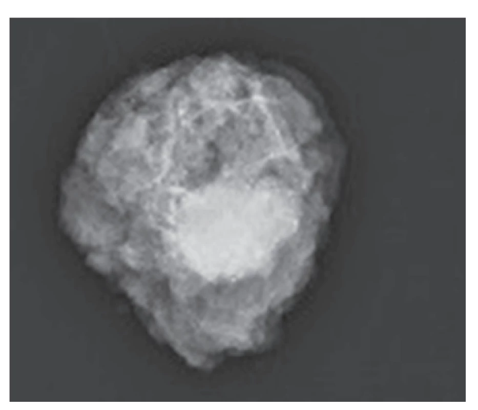 Mamografie resekátu<br>
Fig. 3: Specimen mammography