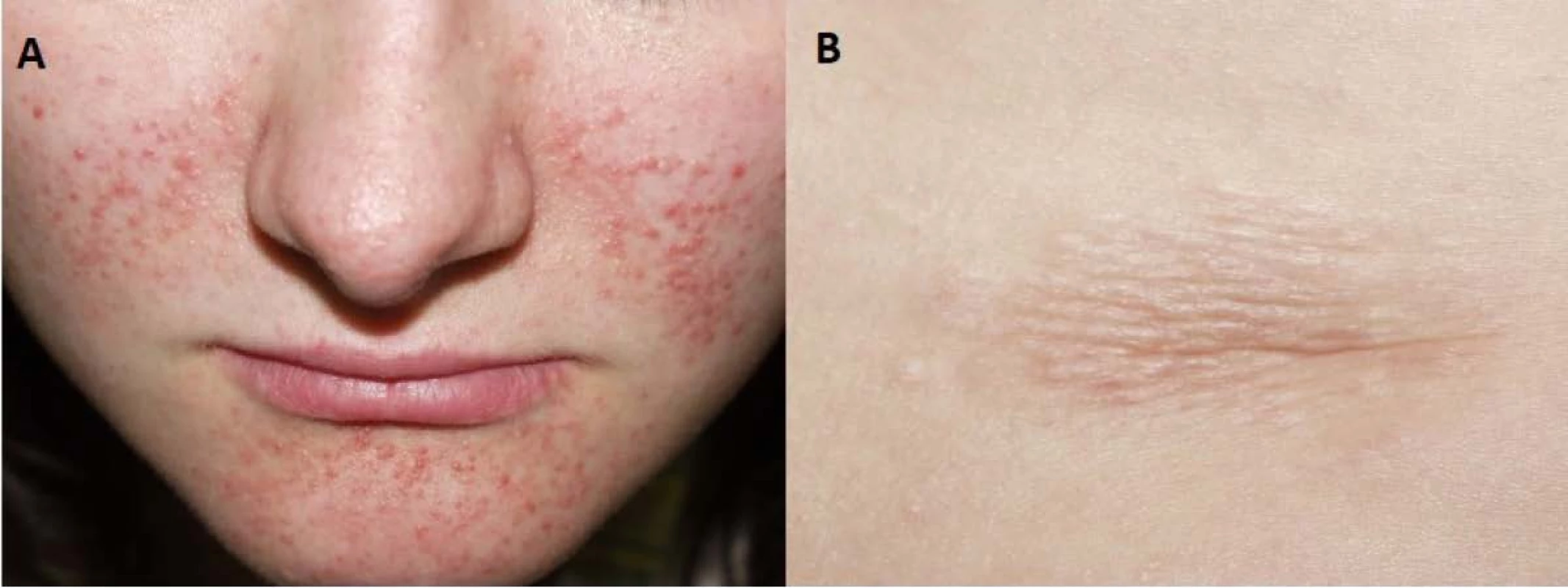 Kožní manifestace u nemocné s tuberózní sklerózou. Faciální angiofibromy (A) a šagrénová skvrna
v typické lokalizaci dolní části zad (B)<br>
Fig. 8. Skin lesions of the patient with tuberous sclerosis. Facial angiofibromas (A) and a shagreen patch (B) in its
typical lower back localization